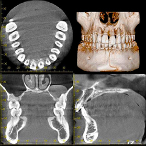 歯科用CT